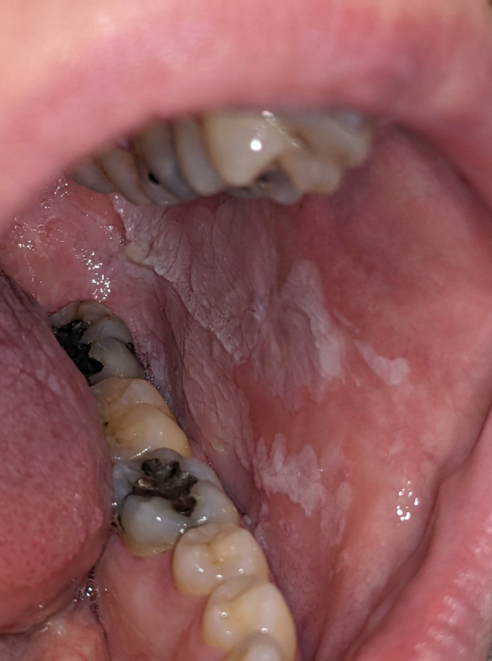 Precancerous Lesion Management (Leukoplakia, Erythroplakia)